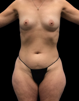 Liposuction: Case 11 - Before