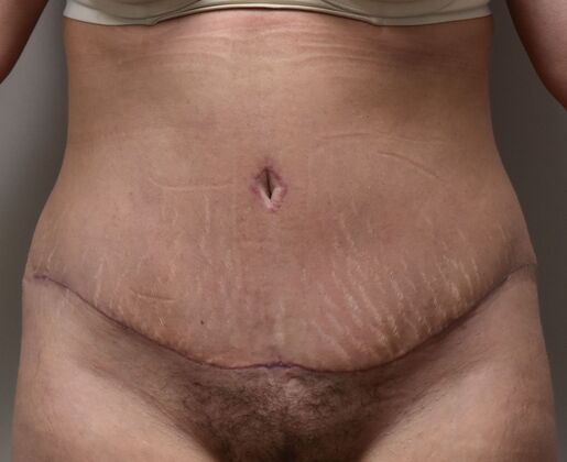 Tummy Tuck (Abdominoplasty): Case 5 - After