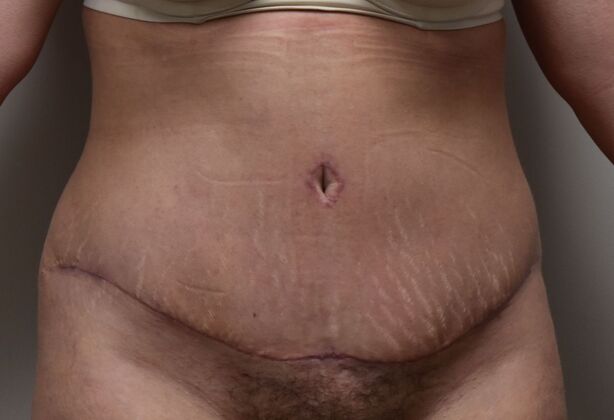 Tummy Tuck (Abdominoplasty): Case 5 - After