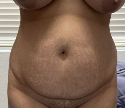 Tummy Tuck (Abdominoplasty): Case 5 - Before