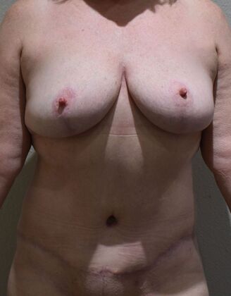 Massive Weight Loss : Case 7 - After