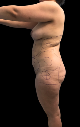 Brazilian Butt Lift Case 9 - Before