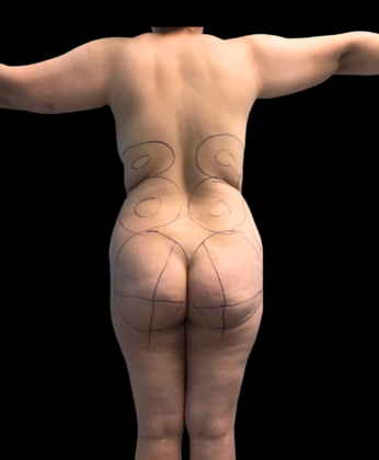 Brazilian Butt Lift: Case 9 - Before