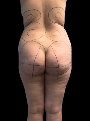Brazilian Butt Lift BBL 18 - Before