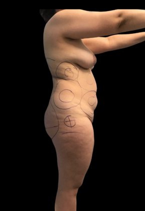 Brazilian Butt Lift: Case 9 - Before