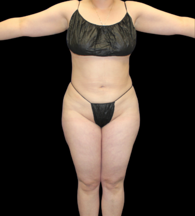 Brazilian Butt Lift: Case 9 - After