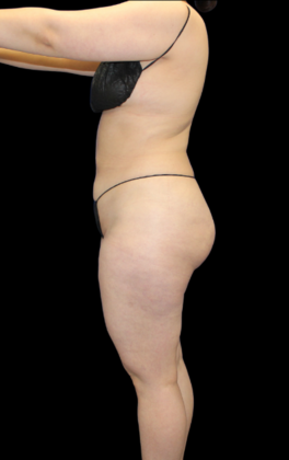 Brazilian Butt Lift Case 9 - After