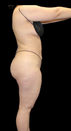 Brazilian Butt Lift: Case 9 - After