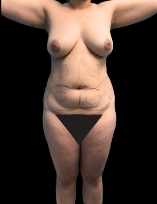 Brazilian Butt Lift: Case 9 - Before