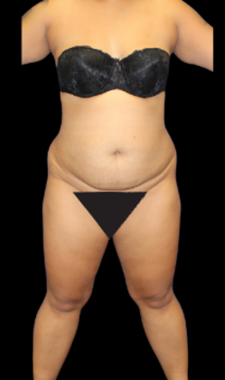 Brazilian Butt Lift: Case 10 - Before