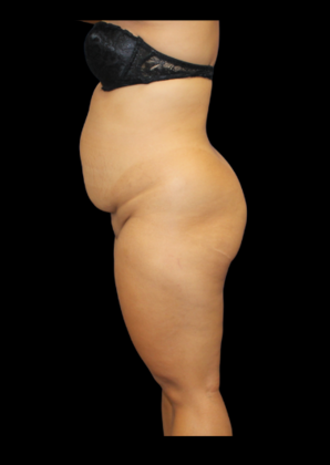 Brazilian Butt Lift Case 10 - Before