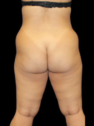 Brazilian Butt Lift BBL 11 - Before
