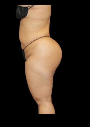 Brazilian Butt Lift Case 10 - After