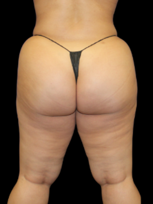 Brazilian Butt Lift BBL 11 - After
