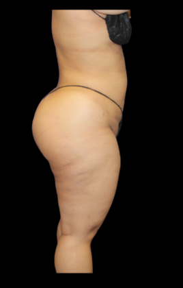 Brazilian Butt Lift: Case 10 - After