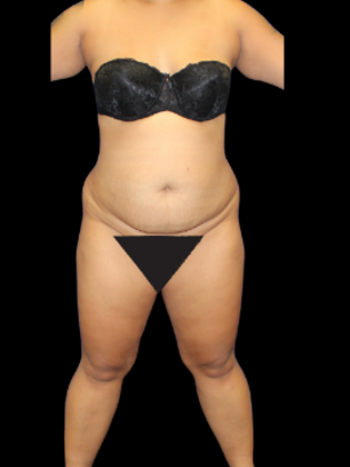 Liposuction Liposuction 8 - Before