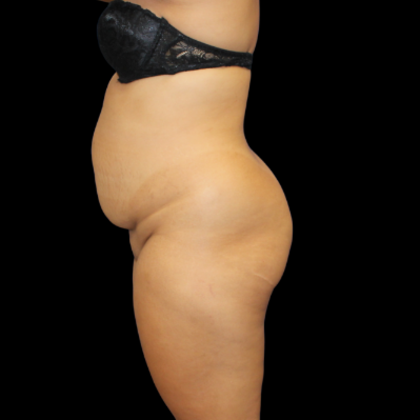 Liposuction Case 12 - Before