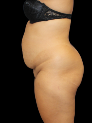 Liposuction: Liposuction 8 - Before