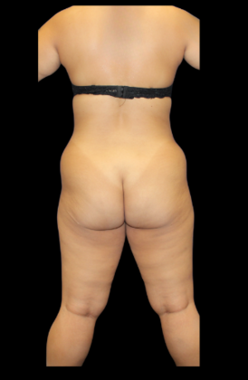 Liposuction: Case 12 - Before