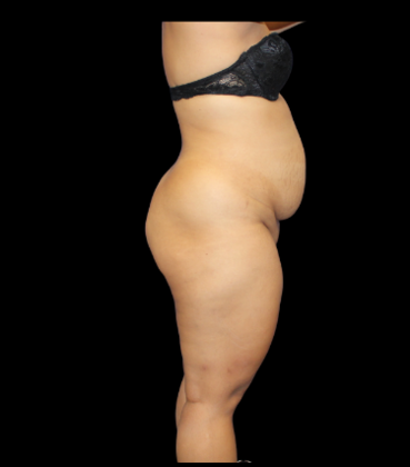Liposuction: Case 12 - Before