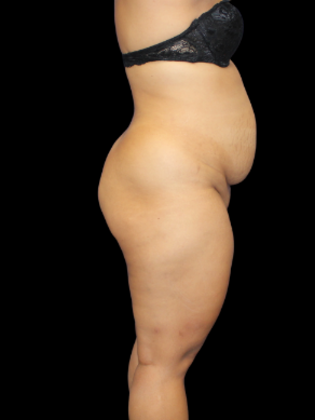 Liposuction: Liposuction 8 - Before