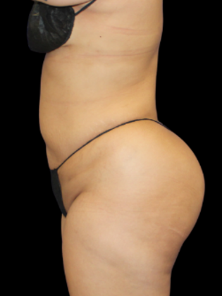 Liposuction: Liposuction 8 - After