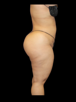Liposuction: Case 12 - After