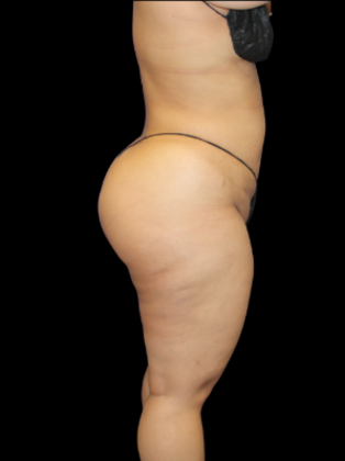 Liposuction: Liposuction 8 - After