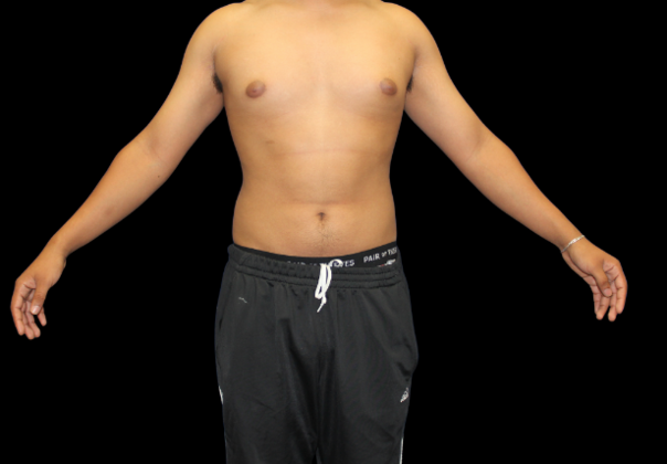 Gynecomastia: Case 2 - Before
