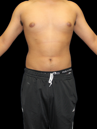 Gynecomastia Gynecomastia 2 - Before
