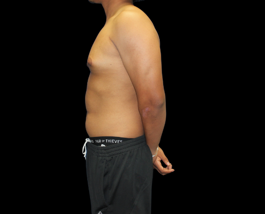 Gynecomastia: Case 2 - Before