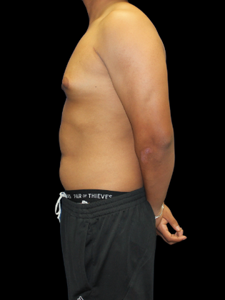 Gynecomastia: Gynecomastia 2 - Before