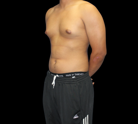 Gynecomastia: Case 2 - Before