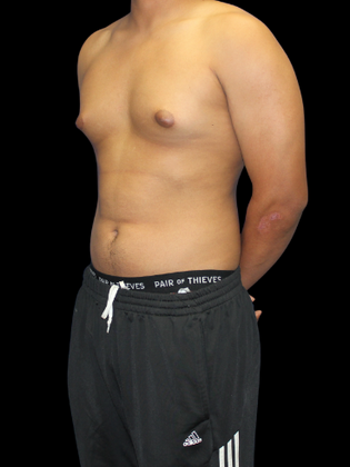 Gynecomastia: Gynecomastia 2 - Before