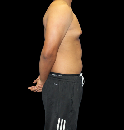 Gynecomastia: Case 2 - Before