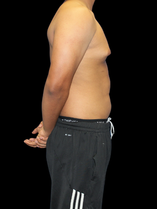 Gynecomastia: Gynecomastia 2 - Before