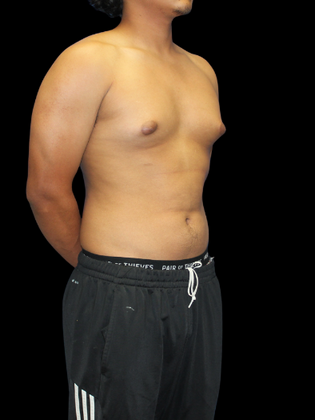 Gynecomastia Case 2 - Before