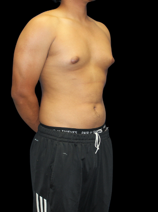 Gynecomastia: Gynecomastia 2 - Before