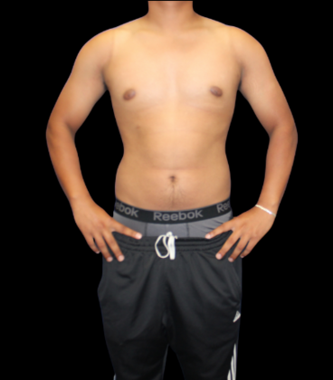 Gynecomastia: Case 2 - After