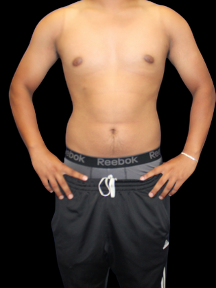 Gynecomastia Gynecomastia 2 - After