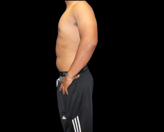 Gynecomastia: Case 2 - After