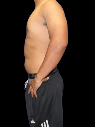 Gynecomastia: Gynecomastia 2 - After