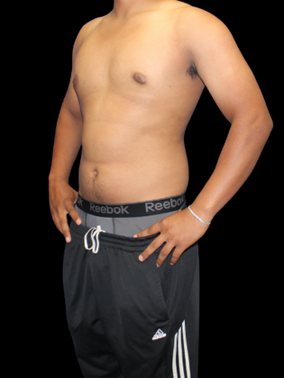 Gynecomastia: Gynecomastia 2 - After