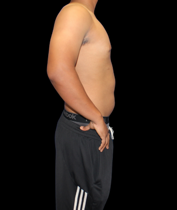 Gynecomastia: Case 2 - After