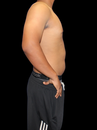 Gynecomastia: Gynecomastia 2 - After