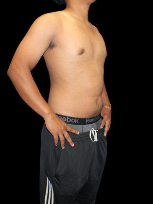 Gynecomastia Case 2 - After