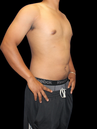 Gynecomastia: Gynecomastia 2 - After