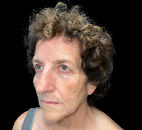 Blepharoplasty: Case 2 - Before