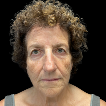 Blepharoplasty Case 2 - Before