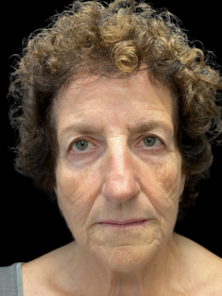 Blepharoplasty Blepharoplasty 2 - Before